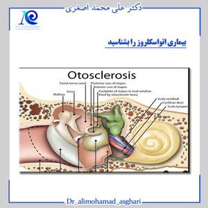 بیماری اتواسکلروز را بشناسید